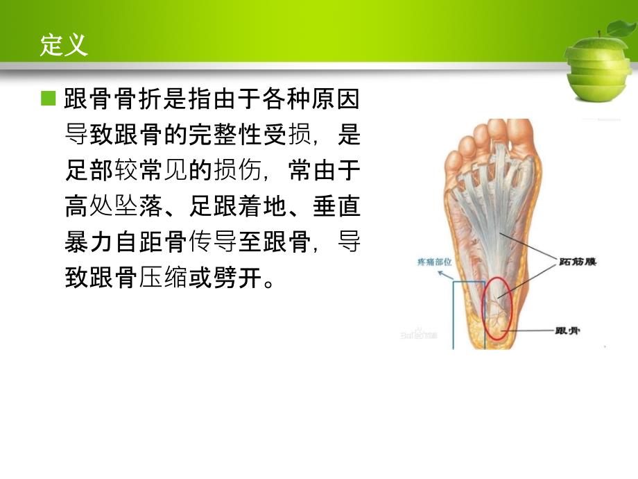 跟骨骨折护理查房课件_第2页