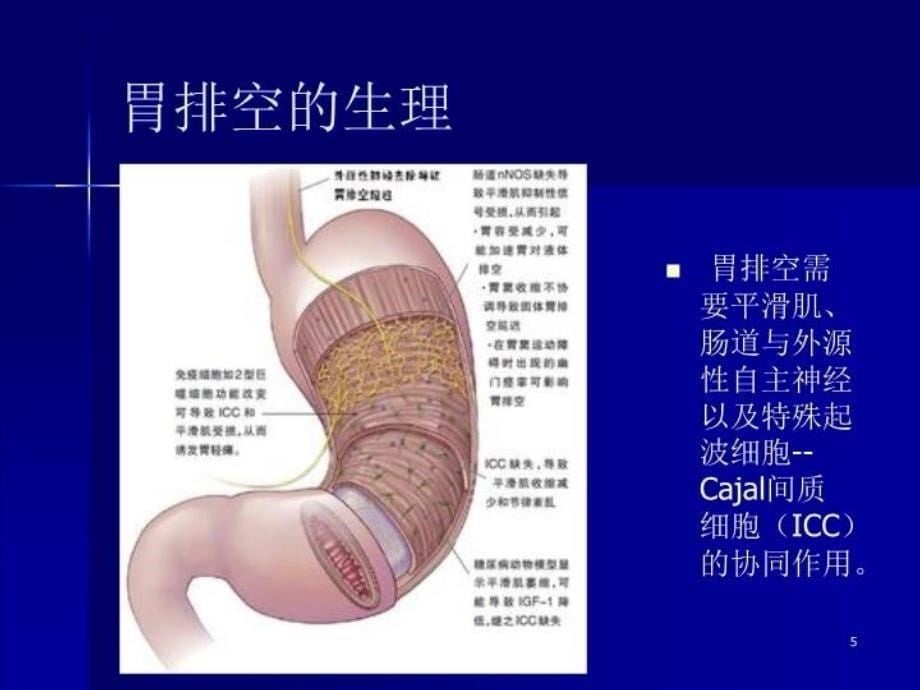 糖尿病胃轻瘫课件_第5页