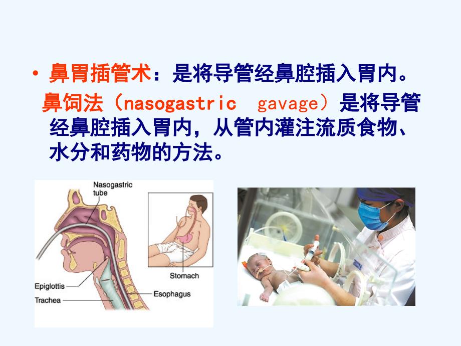 小儿胃管置入术_第2页