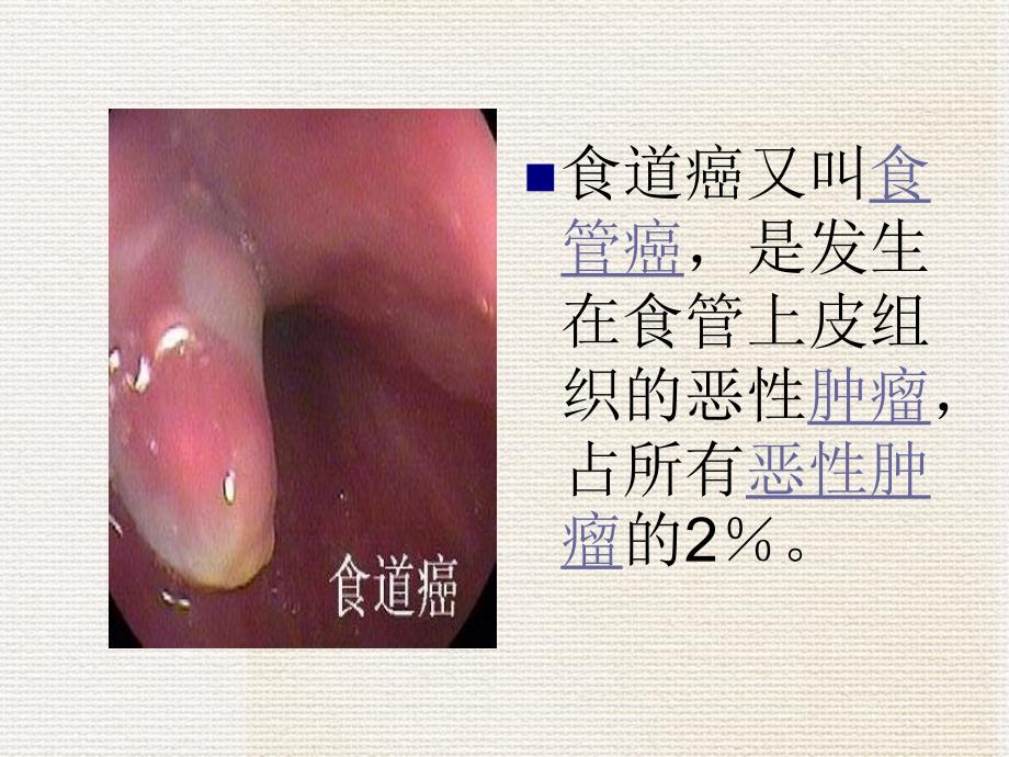 食道癌的课件_第1页