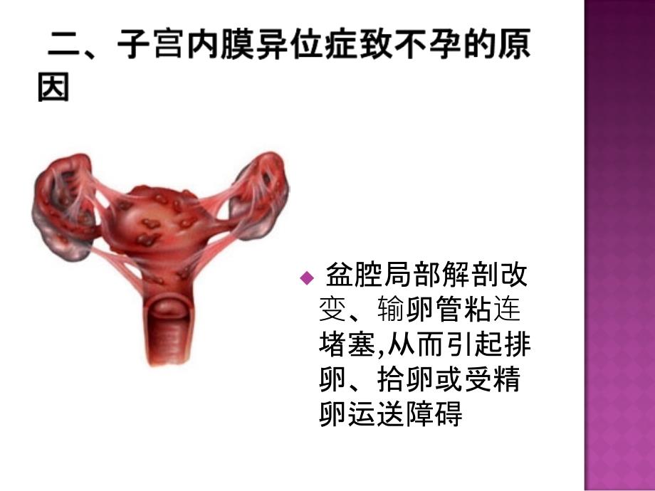 子宫内膜异位症相关不孕_第4页