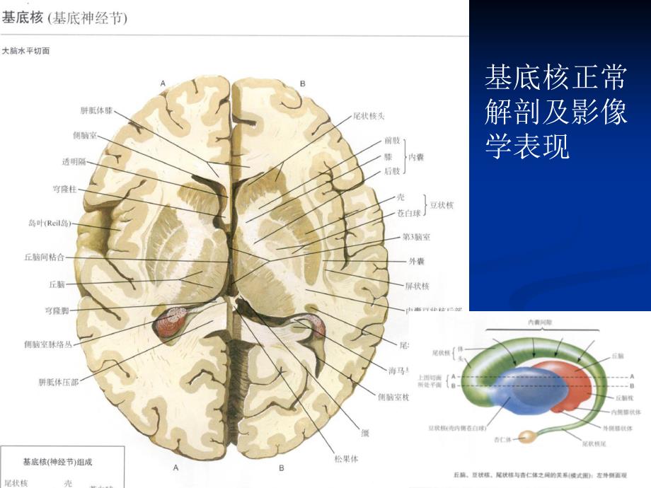 大脑深部对称性灰质核团病变的病因与mri诊断课件_第3页