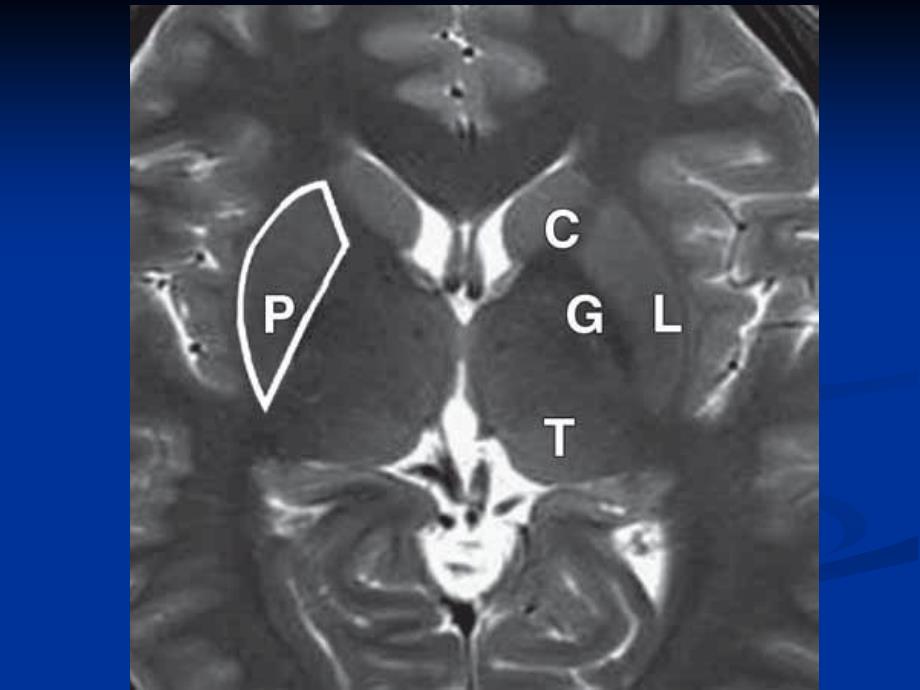 大脑深部对称性灰质核团病变的病因与mri诊断课件_第4页