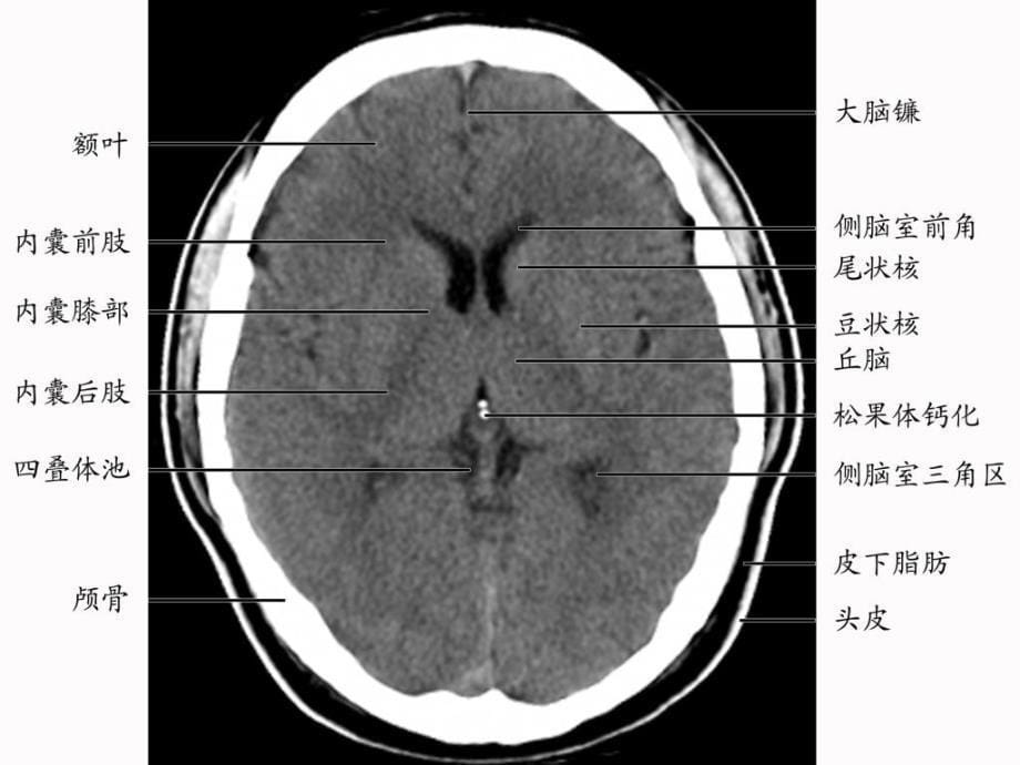 大脑深部对称性灰质核团病变的病因与mri诊断课件_第5页