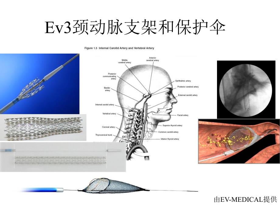 颈动脉支架和保护伞_第1页