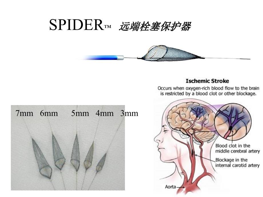 颈动脉支架和保护伞_第4页