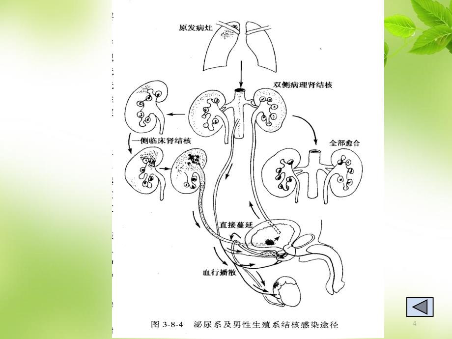 肾结核患者的护理ppt课件_第4页