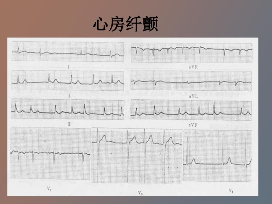 心房纤颤的治疗_第2页