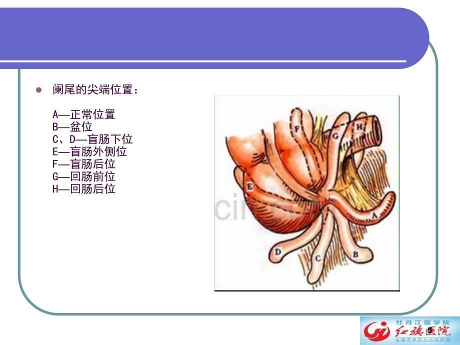 急性阑尾炎影像诊断学ppt课件_第5页