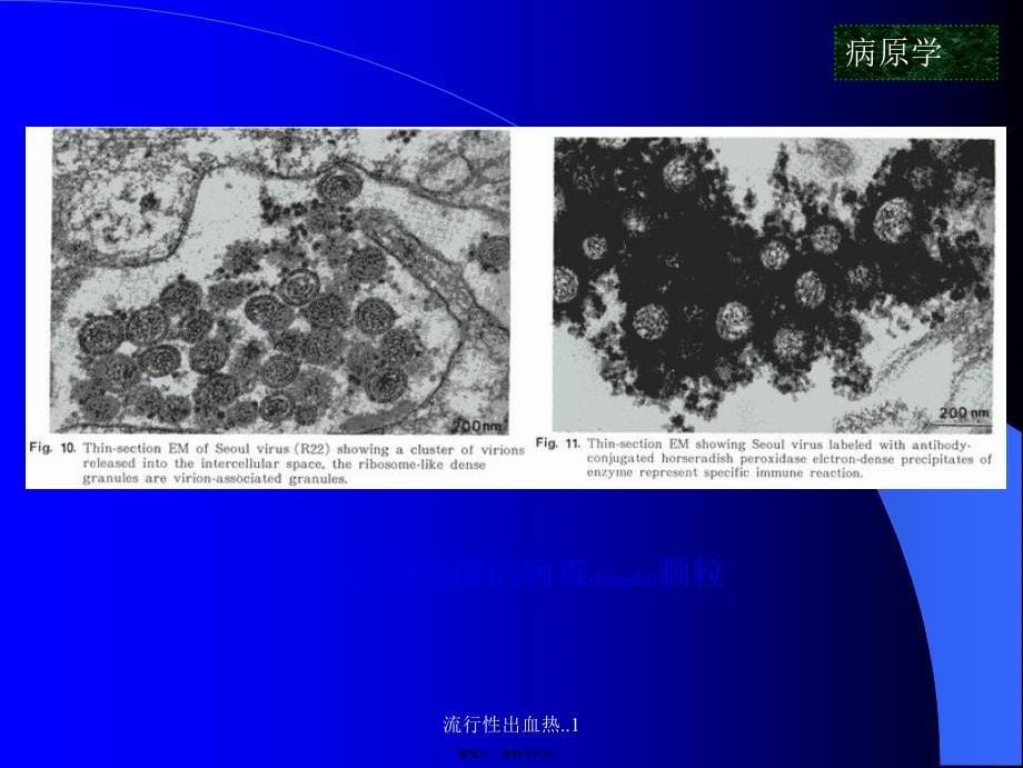 流行性出血热.1课件_第5页