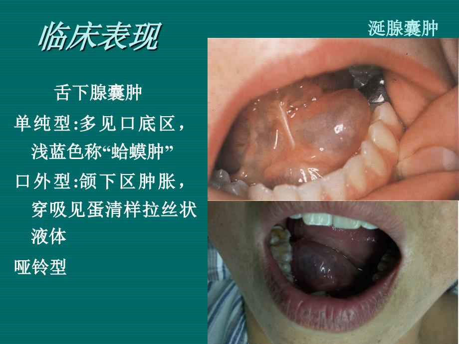 涎腺肿瘤及瘤样病变课件_第4页