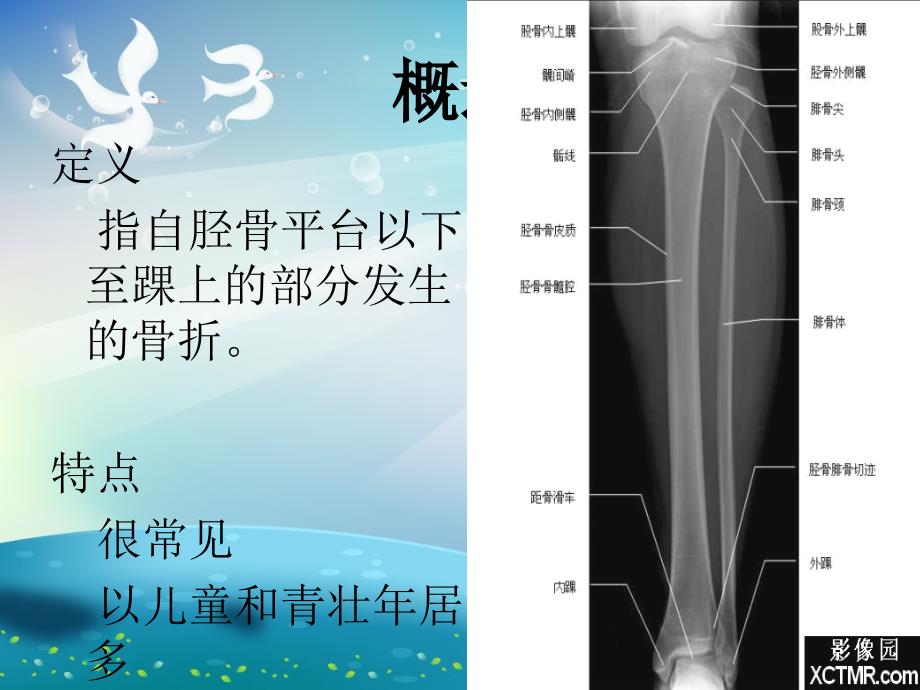 胫腓骨骨折ppt课件_第2页