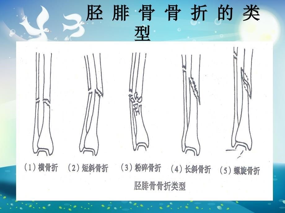 胫腓骨骨折ppt课件_第5页