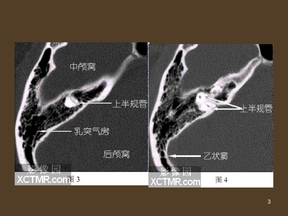 推荐精选耳部最详细CT解剖_第3页