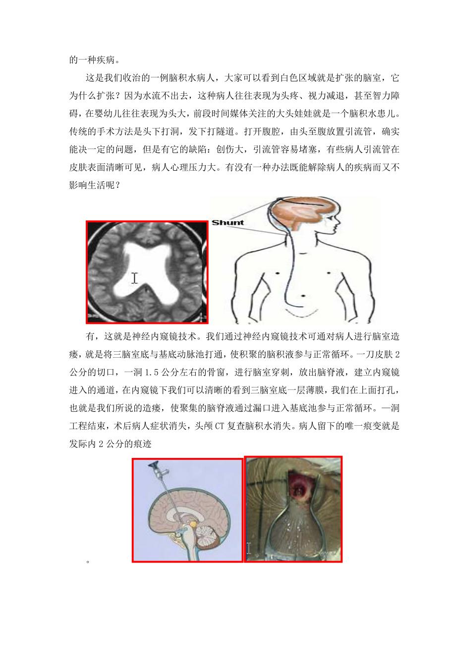 贾栋讲稿一洞工程——神经内窥镜手术.doc_第2页