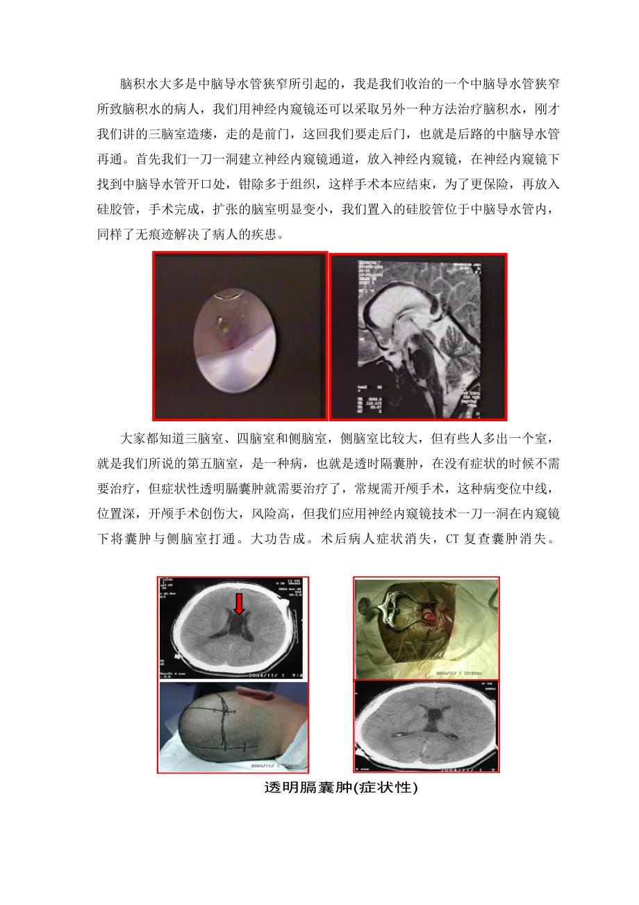 贾栋讲稿一洞工程——神经内窥镜手术.doc_第3页