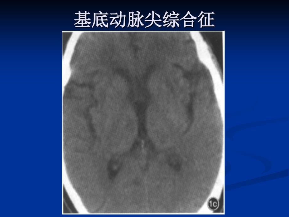 丘脑对称性病变_第5页