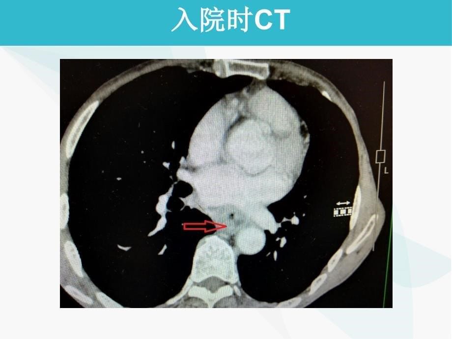 医学交流课件：食管癌伴肾病综合征治疗经验分享和思考_第5页