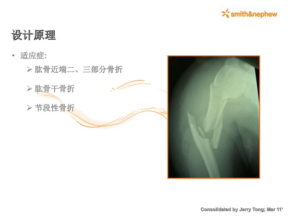 肱骨近端髓内钉_第4页