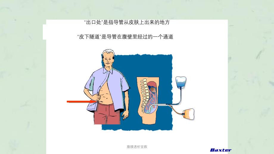 腹膜透析宣教课件_第4页