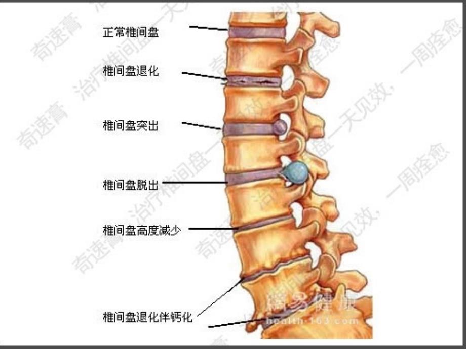 腰椎间盘突出症病人的护理_第3页