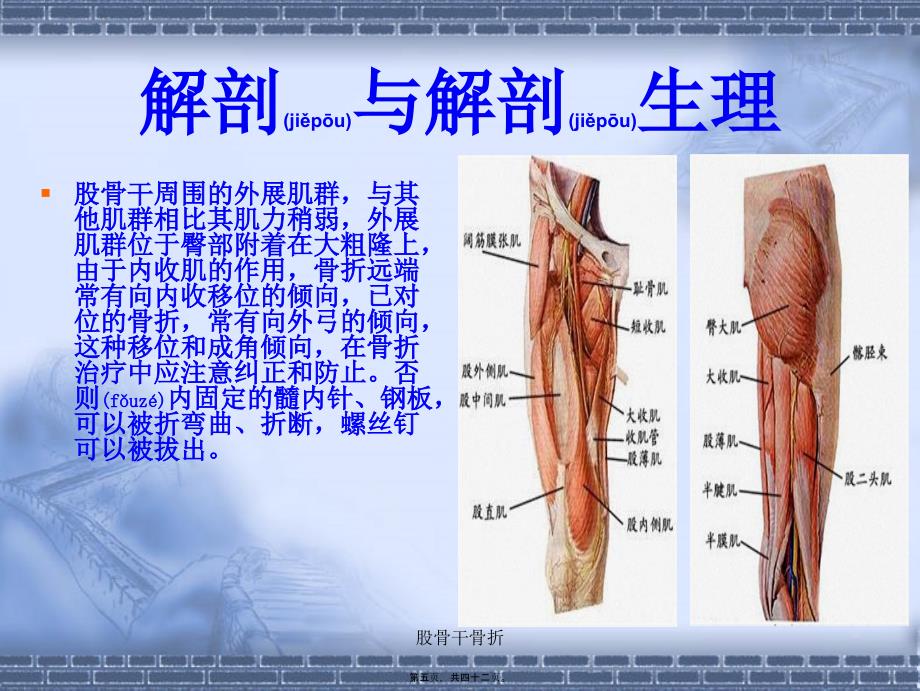 股骨干骨折课件_第5页