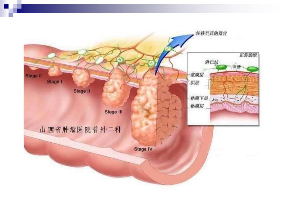 医学课件直肠癌新分期_第4页