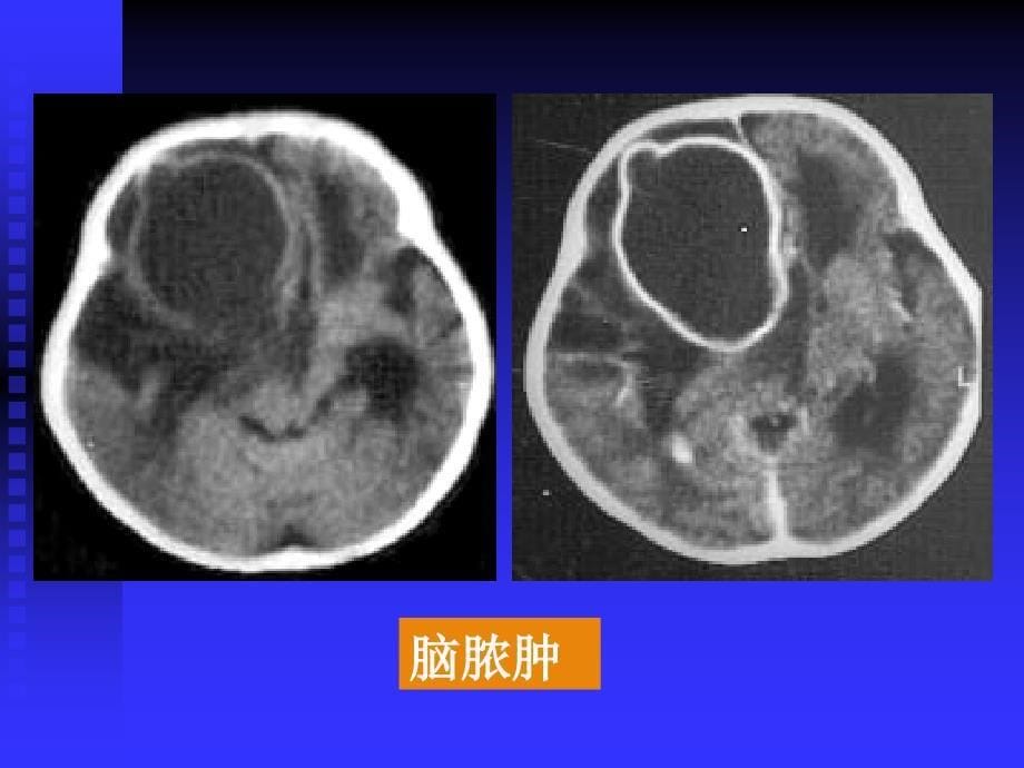 颅内感染疾病_第5页