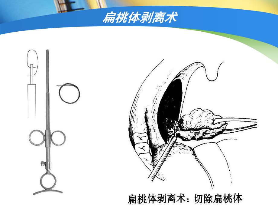 扁桃体术后护理课堂PPT_第4页