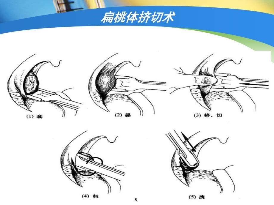 扁桃体术后护理课堂PPT_第5页