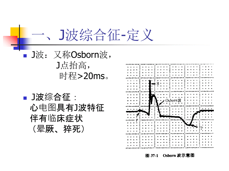 J波综合征精美医学_第2页