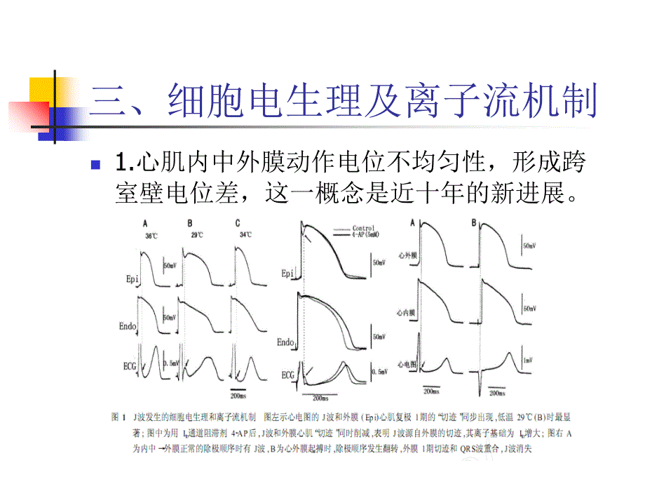 J波综合征精美医学_第4页