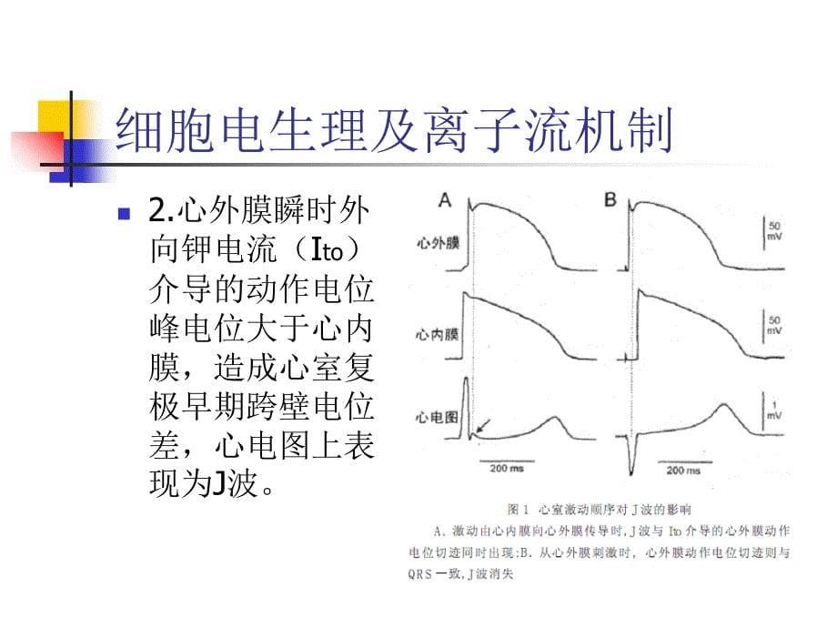 J波综合征精美医学_第5页