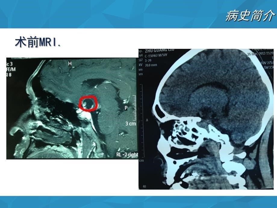 垂体瘤护理查房ppt课件_第5页