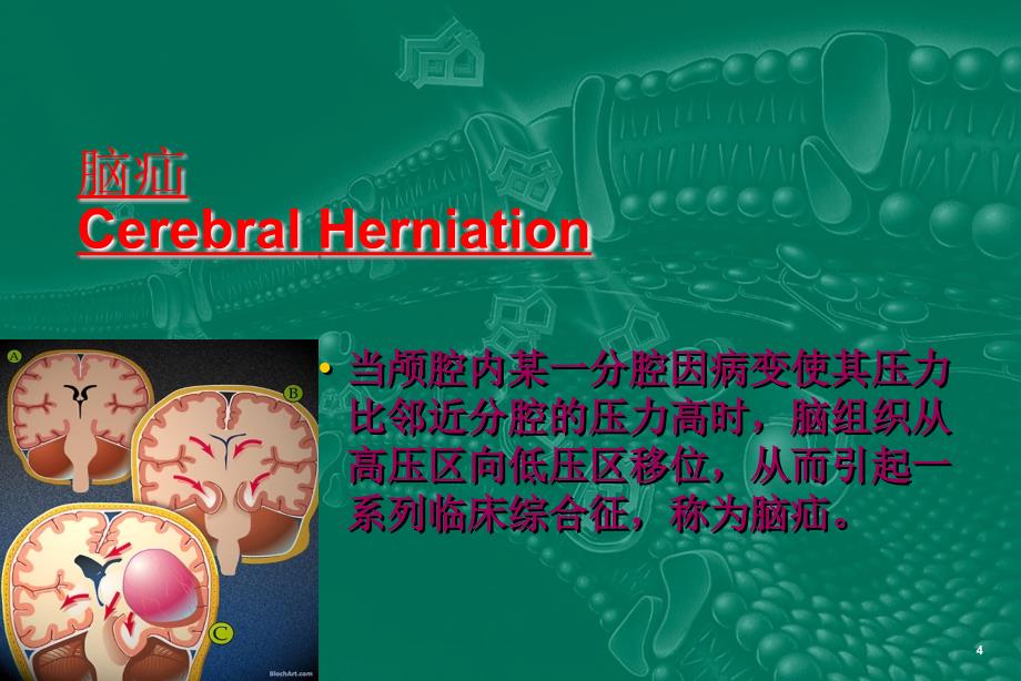 脑疝病人的护理.ppt_第4页