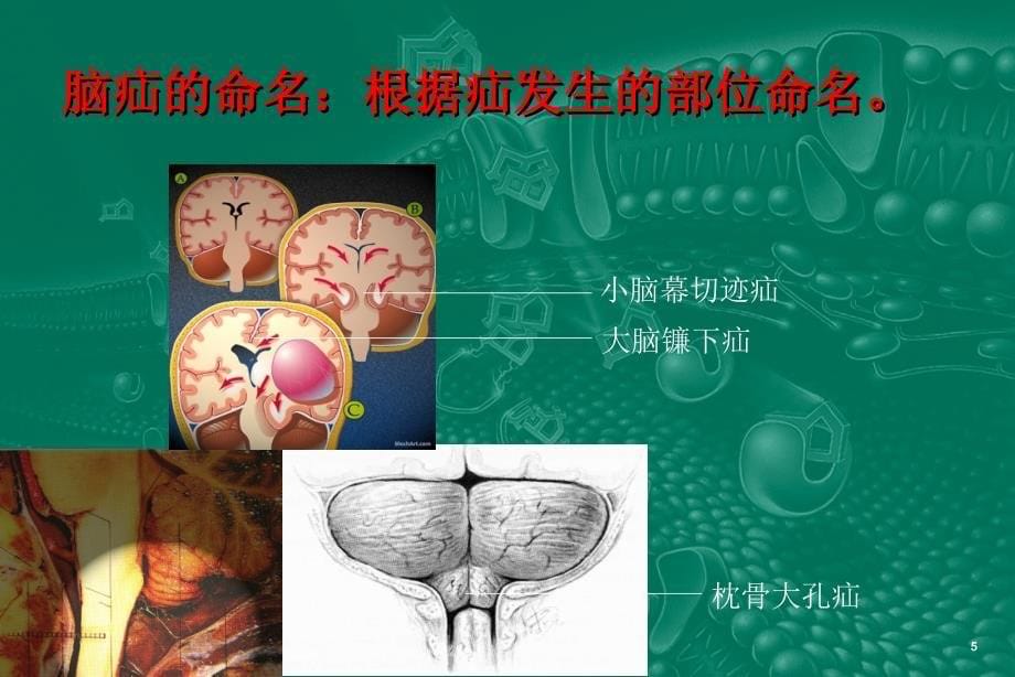 脑疝病人的护理.ppt_第5页