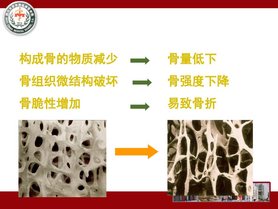 骨质疏松症的康复治疗_第3页