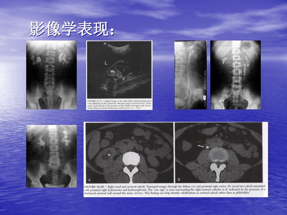 尿石症的微创治疗PPT课件_第3页