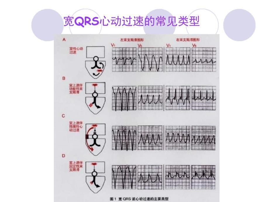 宽QRS心动过速的鉴别诊断_第5页