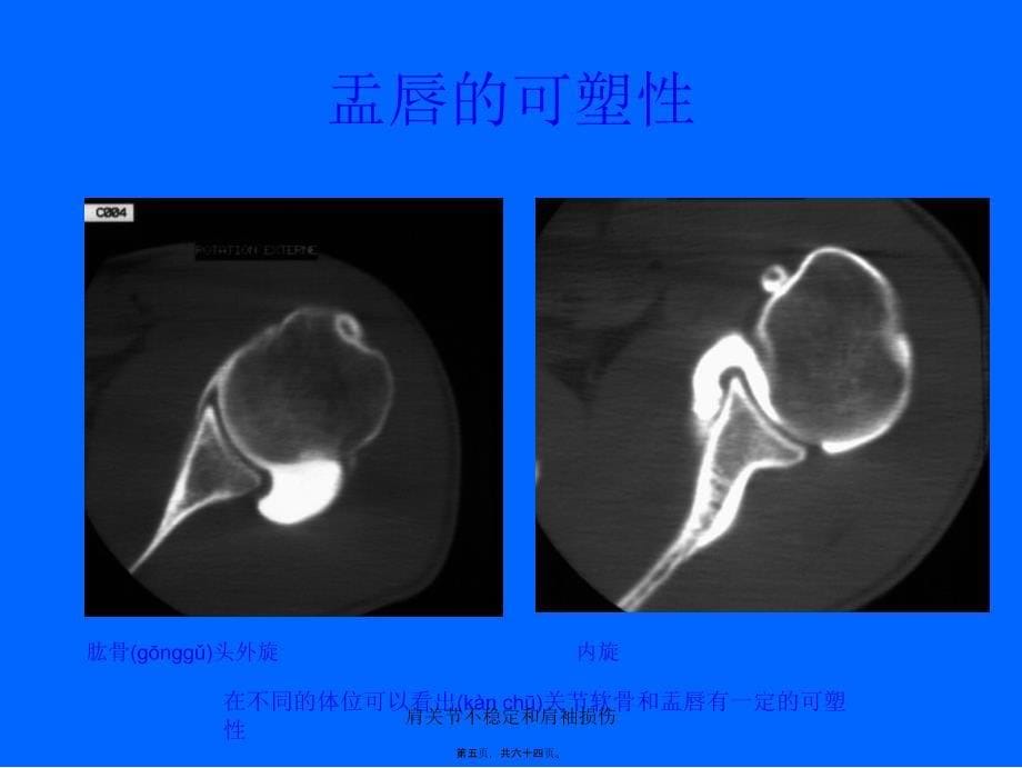 肩关节不稳定和肩袖损伤课件_第5页