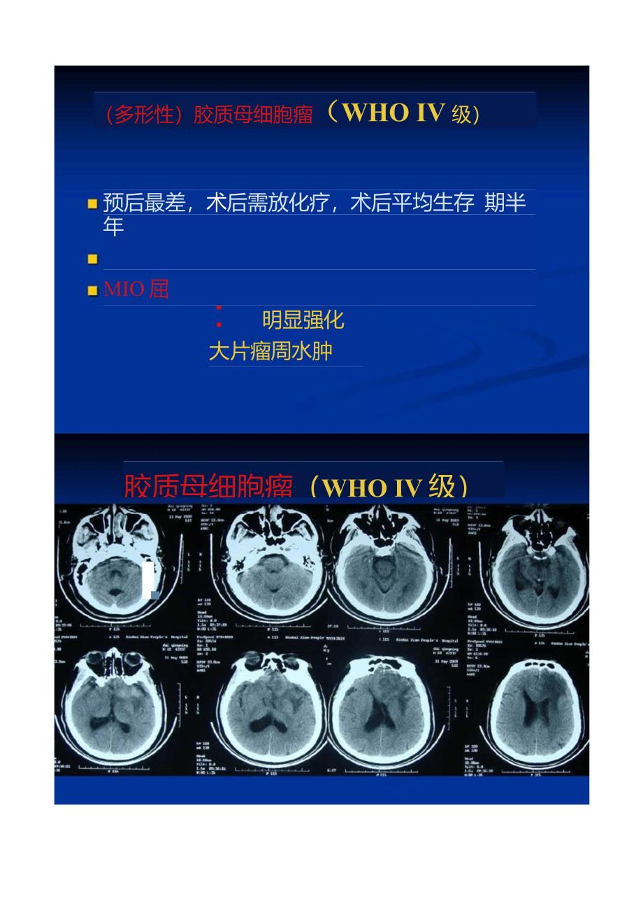 神经外科常见影像学与肿瘤简介02._第3页