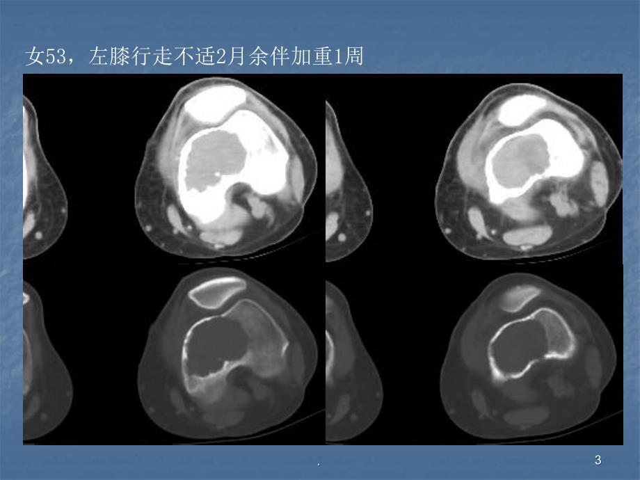 (医学课件)骨巨细胞瘤及纤维组织细胞类肿瘤ppt演示课件_第3页