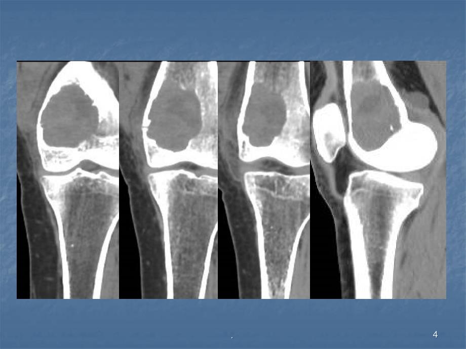 (医学课件)骨巨细胞瘤及纤维组织细胞类肿瘤ppt演示课件_第4页