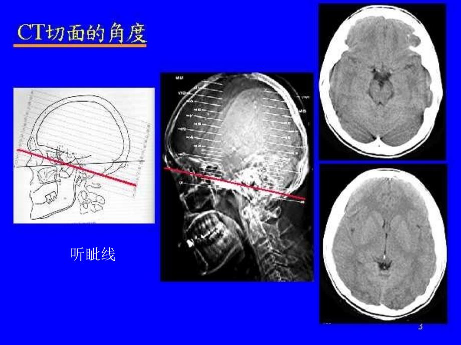 颅脑疾病的CT诊断课件_第4页