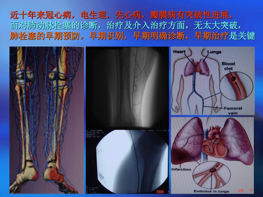 肺栓塞的诊断及介入治疗ppt课件_第2页