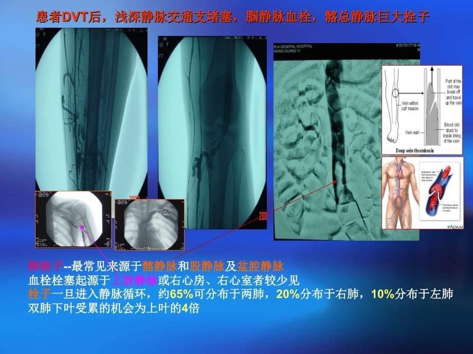 肺栓塞的诊断及介入治疗ppt课件_第5页