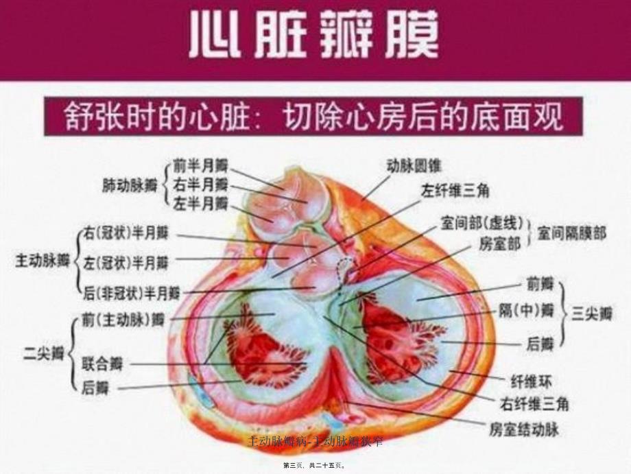 主动脉瓣病-主动脉瓣狭窄课件_第3页