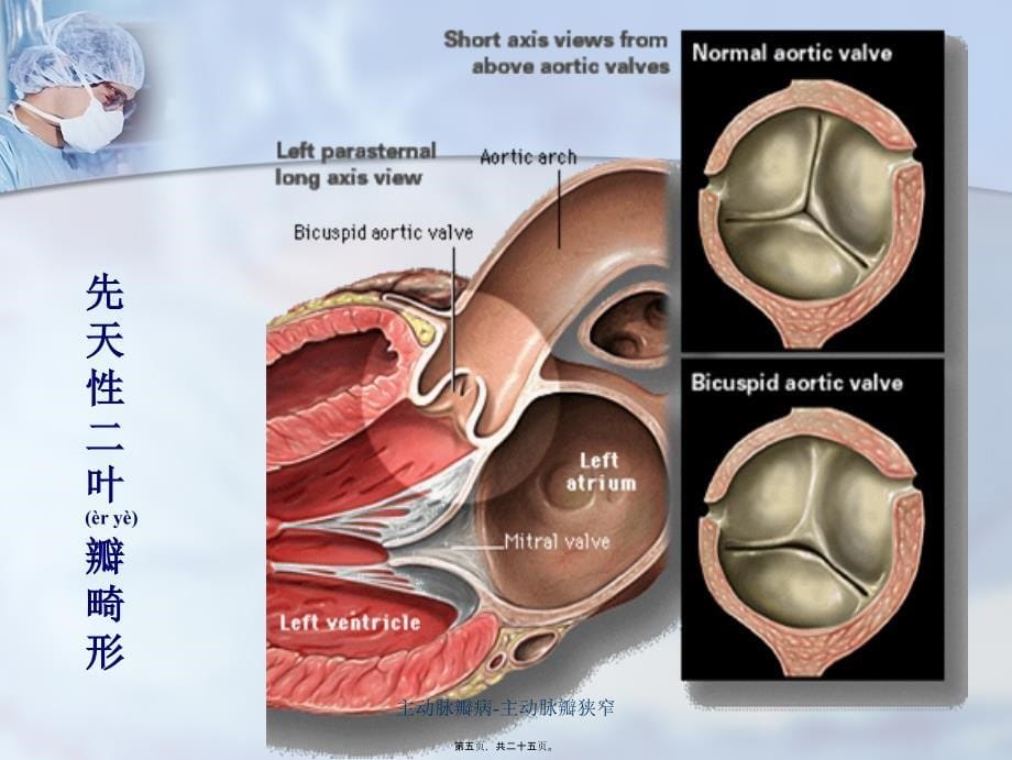 主动脉瓣病-主动脉瓣狭窄课件_第5页