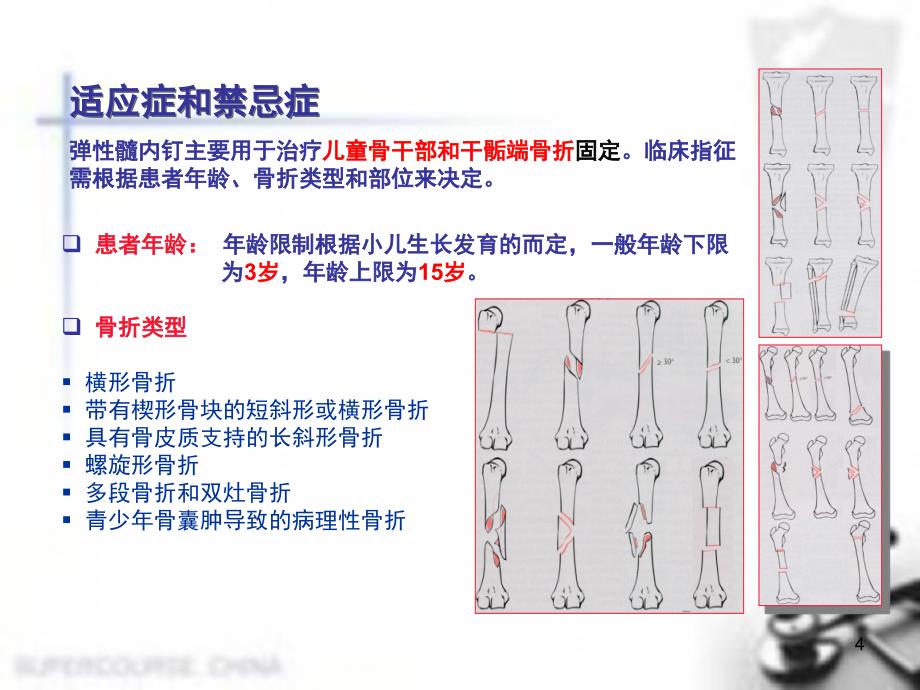 弹性髓内钉幻灯片课件_第4页