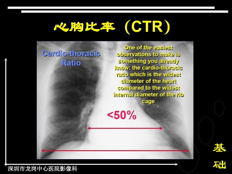 最新心脏疾病ABCPPT课件_第2页